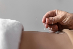 The Basics of Acupuncture The Basics of Acupuncture
